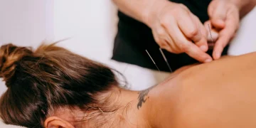 Physiotherapist performing dry needling on a patient's back to relieve muscle pain and trigger points at Attwood Physiotherapy.